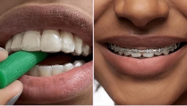 Exclusive Smile braces vs invisalign
